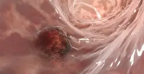 Pesquisa aponta para substância que reduz risco de câncer