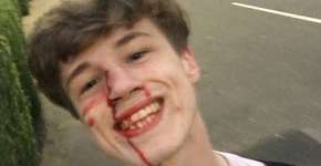 Ensanguentado, jovem posta foto sorrindo após agressão homofóbica