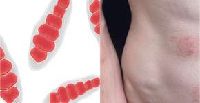 Superfungo genital difícil de tratar é detectado em alguns países