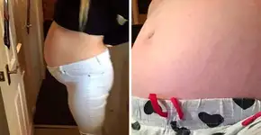 Mulher descobre estar grávida e ter um cisto no ovário