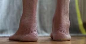 Cardiologistas alertam: este sintoma nos pés frequentemente ignorado pode indicar insuficiência cardíaca