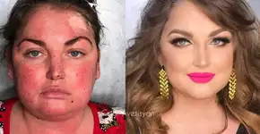 Vítimas de câncer e queimaduras passam por transformação incrível