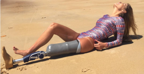 Modelo que teve perna amputada é exemplo de superação