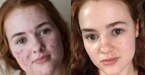 Web reacende debate sobre Roacutan; veja o que o remédio pode causar