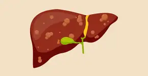 Fique atento aos sintomas de gordura no fígado e cuide da sua saúde hepática a tempo