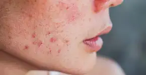 Dieta rica em alimentos antioxidantes ajuda a melhorar a acne, diz estudo