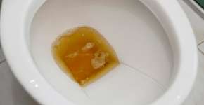 Cor da urina pela manhã pode revelar sobre sua reação ao estresse