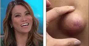 Bizarro: programa americano traz médica espremendo espinhas