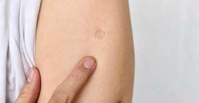 Tuberculose ainda preocupa: saiba como se proteger e evitar o contágio