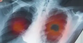 O câncer de pulmão em não fumantes