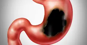 Anvisa suspende comercialização e uso do lote de Omeprazol