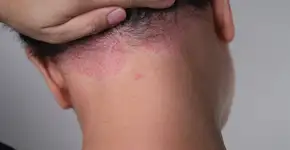 Cientistas revelam novo suspeito por trás da psoríase