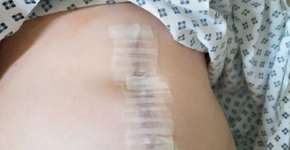 Desafio do TikTok faz menina perder parte do intestino