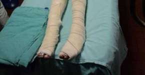 Garota tem 80% do corpo queimado pelo companheiro no RS