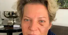 “Apagão” e outros efeitos do remédio usado por Joice Hasselmann