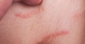 8 tipos de tratamentos para eliminar as estrias vermelhas