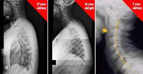 Imagens em raio-x mostram as consequências do uso da tecnologia para o corpo
