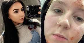 Cosmético popular causa queimaduras em rosto de jovem