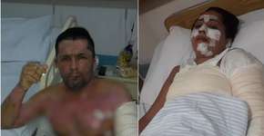 Sem gás, família se queima ao usar álcool e precisa de ajuda para tratamento