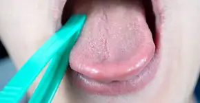 Manchas na língua? Conheça a língua geográfica e saiba se é o seu caso