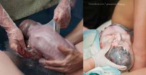 Fotos raras exibem bebês que nasceram envoltos na bolsa amniótica