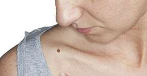 App ajuda usuários a identificarem câncer de pele