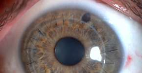 Campanha por doação de córnea espalha olhos pela cidade