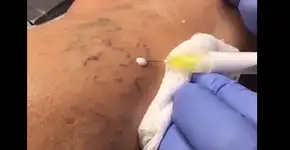 Vídeo mostra técnica que faz varizes e vasinhos sumirem na hora