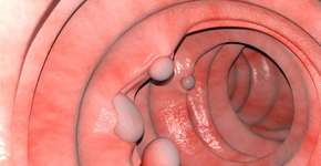 Atenção para sinal sutil de câncer de intestino