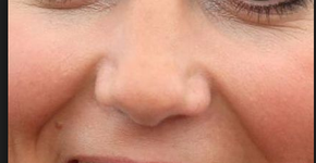 Celebridades inspiram cirurgias plásticas