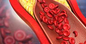 Saiba como controlar o colesterol ruim