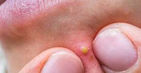 Furúnculo: sete mitos e verdades esclarecidos por especialistas