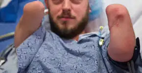 Homem que foi atingido por bomba ganha braços novos com cirurgia