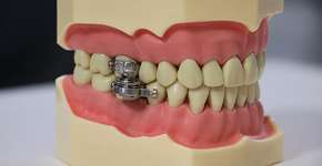 Dispositivo de emagrecimento que trava a boca é criticado por especialistas