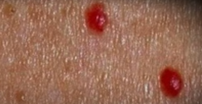 Pintas vermelhas na pele: o que são, causas e como tirar