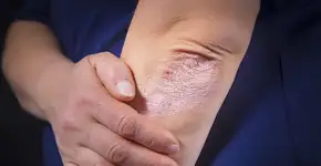 Psoríase: conheça os sinais e tratamentos da doença