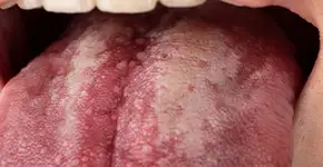 O que a sua língua pode revelar sobre candidíase oral