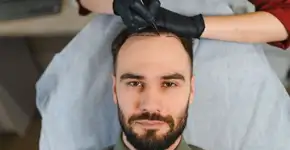 Transplante capilar: entenda quando pode ser necessário refazer o procedimento