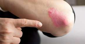 Estudo mostra como a vitamina D tem influência direta na psoríase