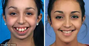 Rosto de garota é transformado por cirurgia na mandíbula