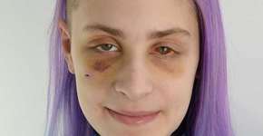 Vítima de violência doméstica teve o cabelo arrancado