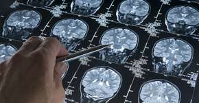 Novo sinal de Alzheimer aparece até 25 anos antes da doença; saiba qual