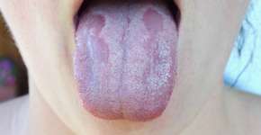 Língua branca pode indicar problemas sérios de saúde; veja causas e tratamentos