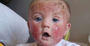 Mãe faz alerta após cremes causarem feridas na filha