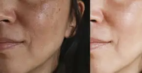 Manchas na pele: entenda o que é melasma e quais os tratamentos