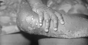 Foto: (Centro de Controle e Prevenção de Doenças dos Estados Unidos/Wikimedia Commons)