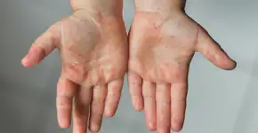 7 respostas para se proteger contra o sarampo, que volta a preocupar