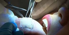 Tela costurada na língua: técnica radical é usada para emagrecer