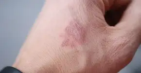 Sinais precoces em suas mãos de que algo está errado com o pâncreas