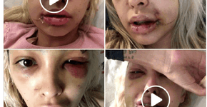 Brasileira expõe agressão de namorado DJ alemão